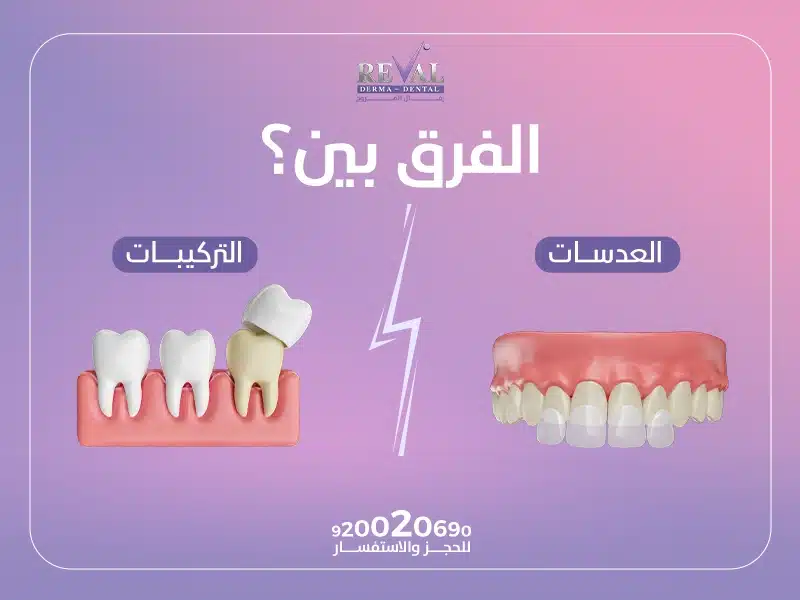 أسعار عدسات الأسنان وتركيبات الأسنان في الرياض