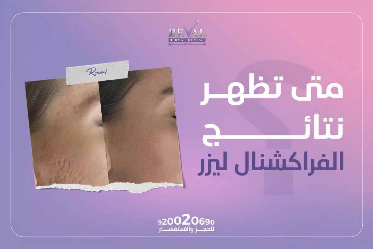 متى تظهر نتائج الفراكشنال ليزر⁉️ ما هي مراحل التعافي من الفراكشنال ليزر؟