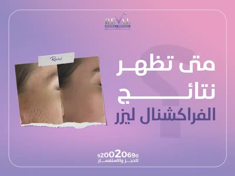 فوائد الفراكشنال ليزر