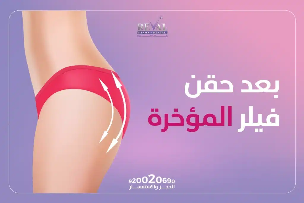 بعد حقن فيلر المؤخرة | كيفية الجلوس بعد حقن الفيلر في المؤخرة؟