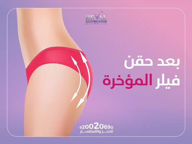 تجربتي بعد حقن فيلر المؤخرة