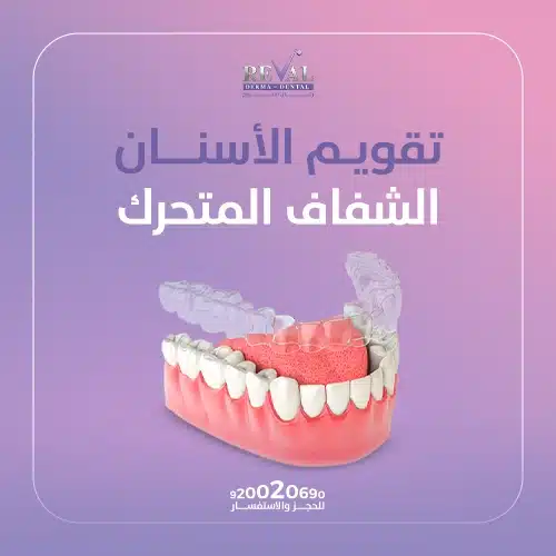 اسعار تقويم الأسنان الشفاف في الرياض
