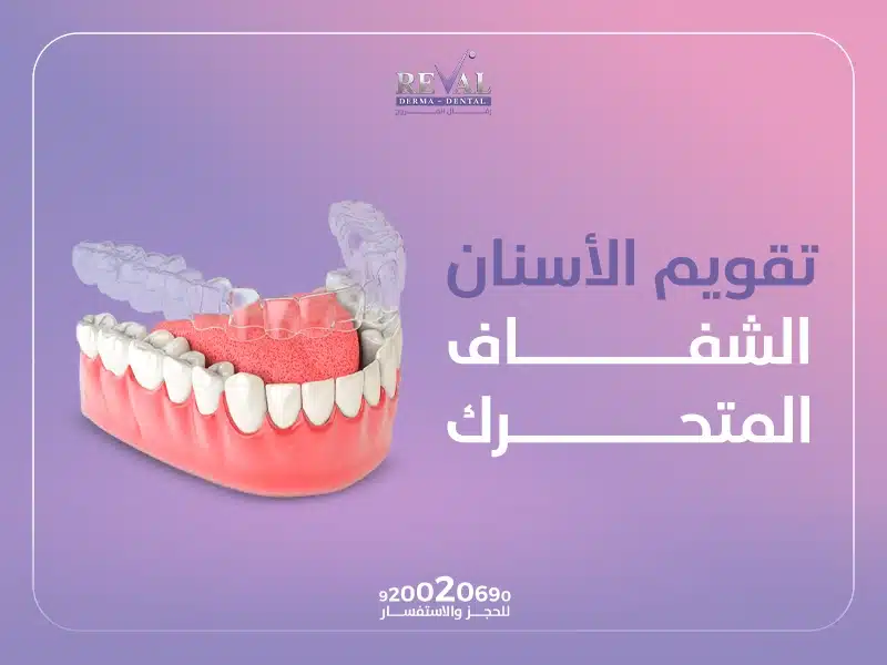 كل ما تحتاج معرفته عن تقويم الأسنان الشفاف المتحرك: كم مدة لبس التقويم الشفاف؟