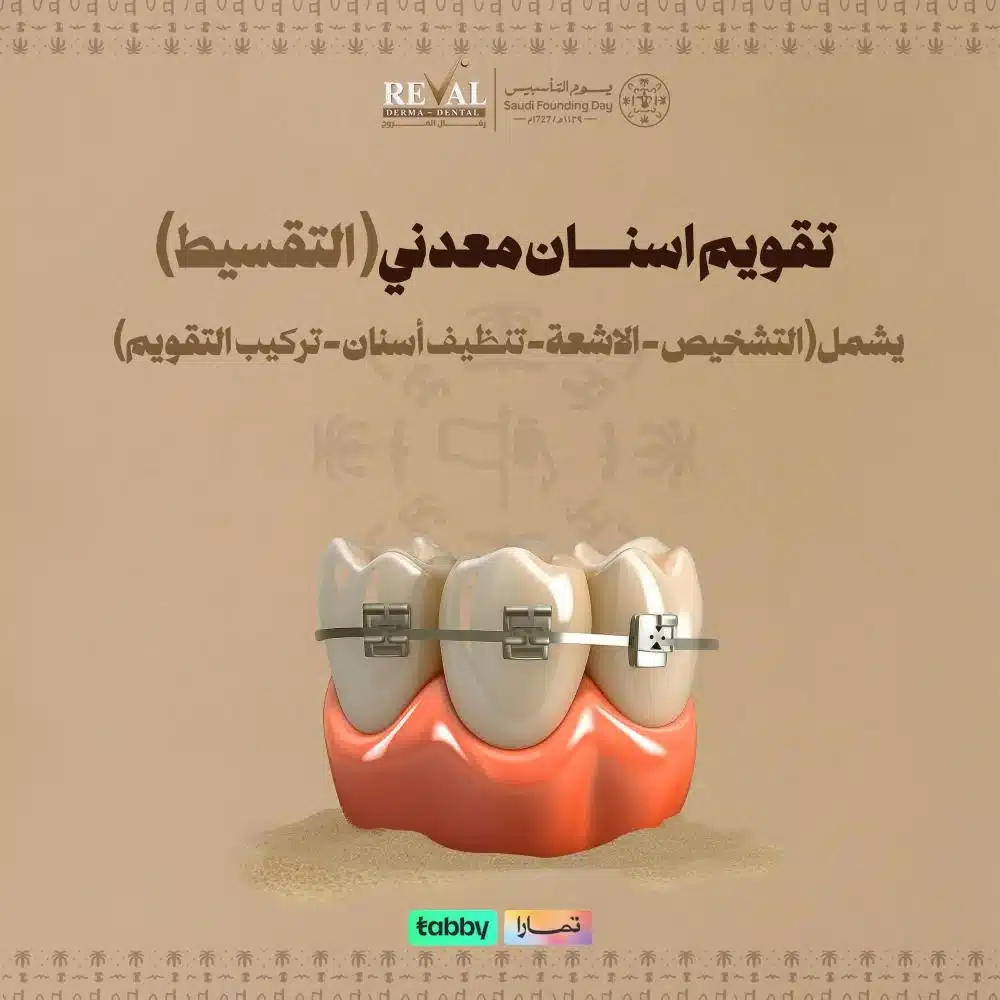 عروض تقويم الأسنان المعدني (الأقساط) في يوم التأسيس