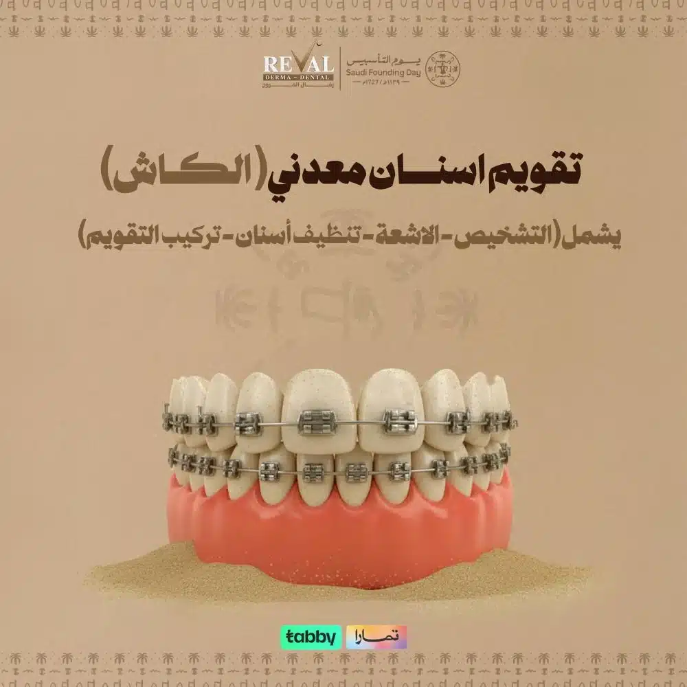 عروض تقويم الأسنان المعدني (كاش) في يوم التأسيس