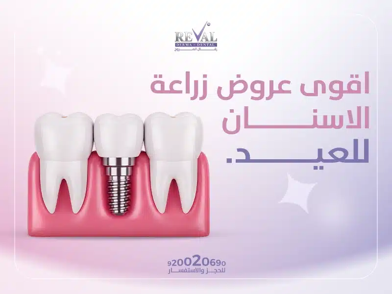 عروض زراعة الأسنان للعيد: استعد لضحكة مكتملة وثقة لا حدود لها