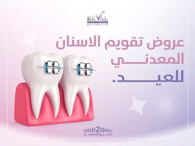 عروض تقويم الاسنان المعدني للعيد: ابتسامة واثقة في موسم الفرح