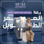 من هو أفضل استشاري زراعة أسنان في الرياض؟ كيف تغير زراعة الأسنان جودة حياتك؟