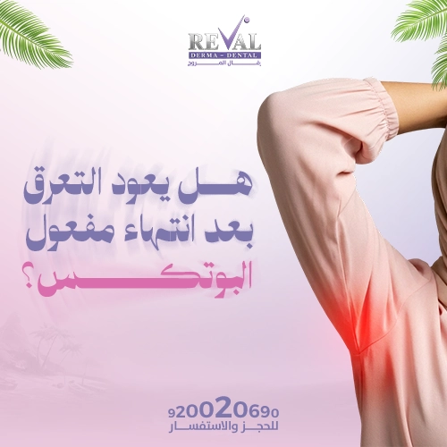 كم تدوم نتائج بوتكس التعرق