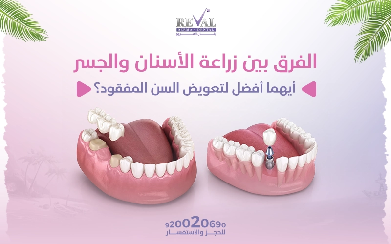 الفرق بين زراعة الأسنان والجسر