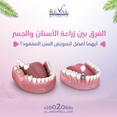 هل تدوم زراعة الأسنان والجسر العمر نفسه؟