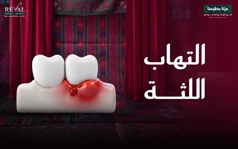التهاب اللثة وأسبابه وأعراضه