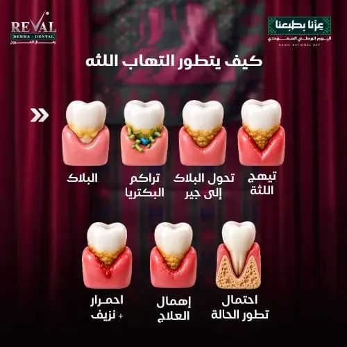 علامات تطور التهاب اللثة