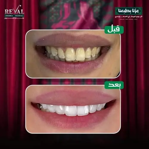قبل وبعد ابتسامة هوليود في رفال المروج