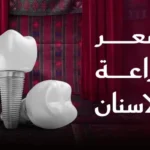 سعر زراعة الاسنان في الرياض