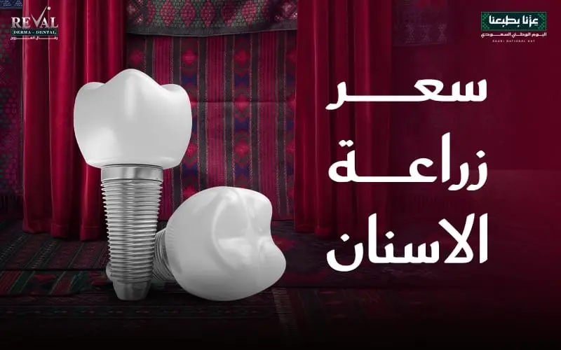 سعر زراعة الاسنان في الرياض