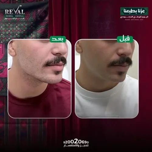 تحديد الفك بالفيلر في عيادات رفال المروج بالرياض
