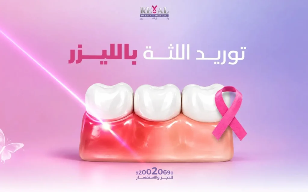 توريد اللثة بالليزر