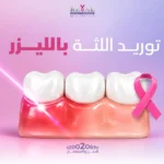 توريد اللثة بالليزر